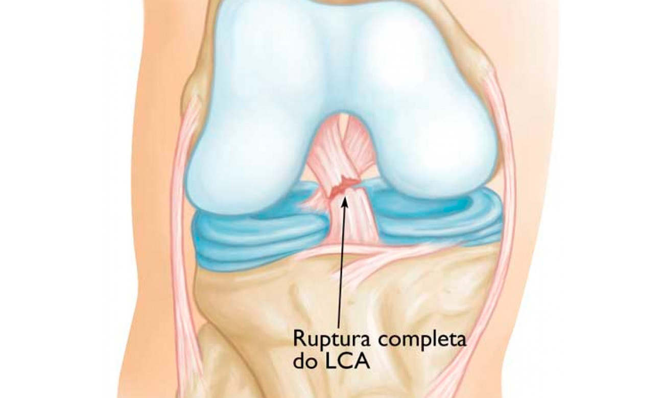 Rompimento LCA Centro de Medicina Avançada Cavalheiro