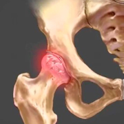 Artrose no quadril, quais são os sintomas e como o tratamento é feito