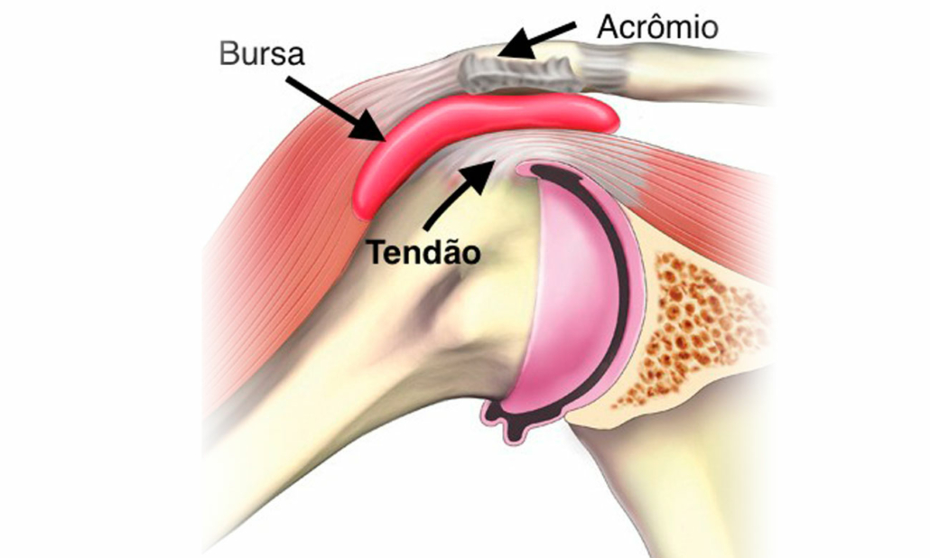 Tendinite Ou Bursite? Entenda As Diferenças E Como Tratar – HYSK